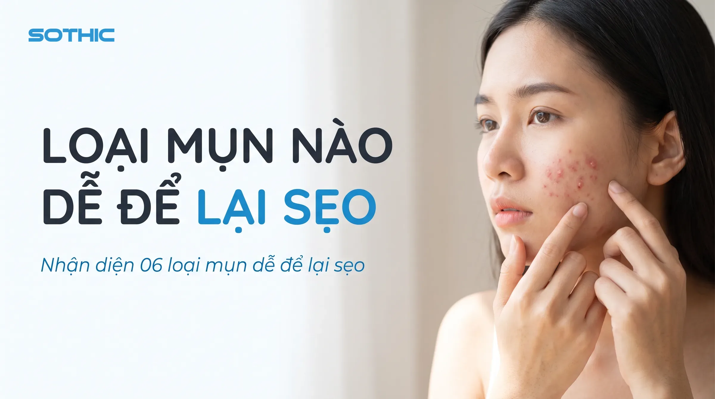 Mụn dễ để lại sẹo