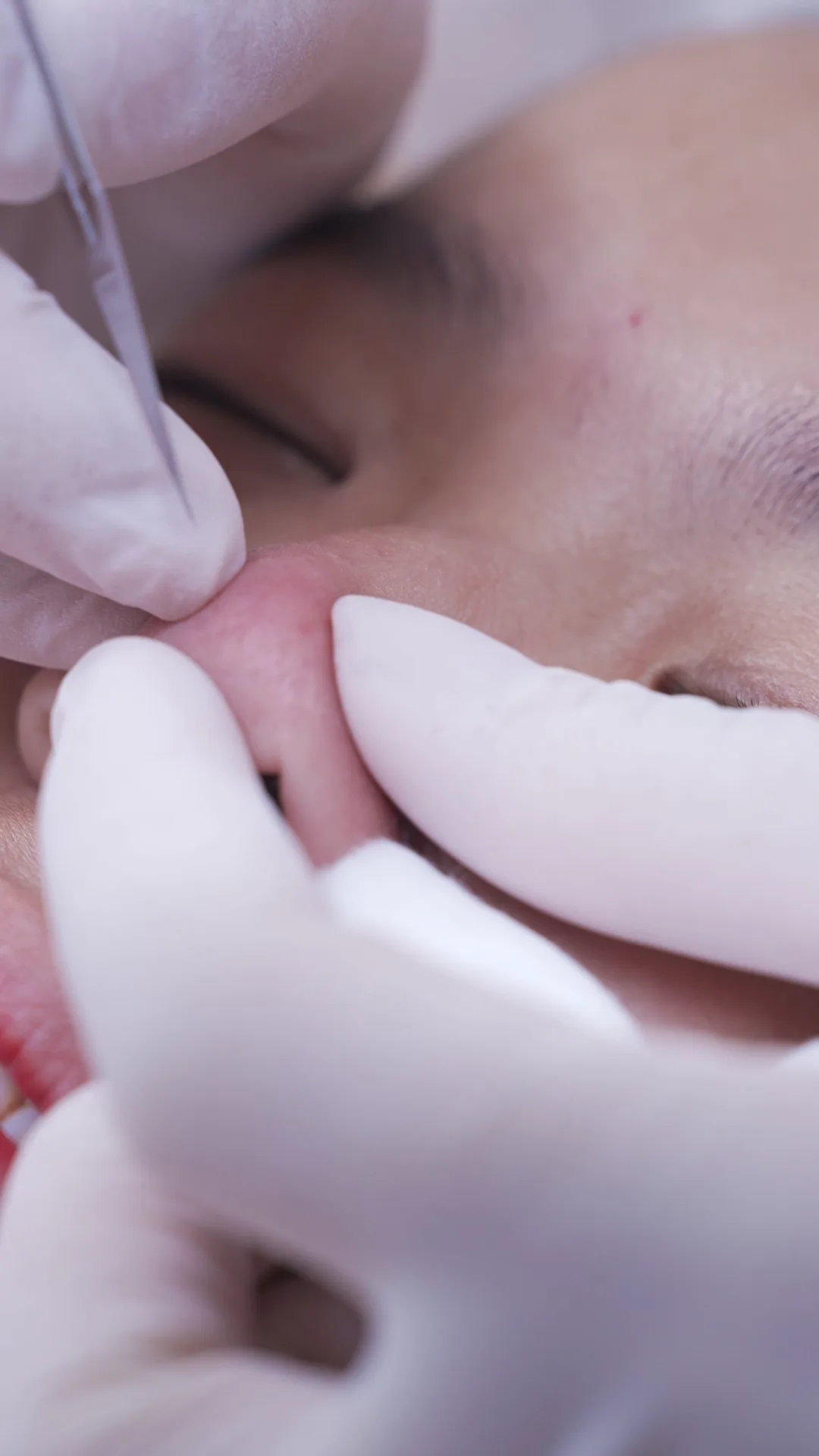 Kỹ thuật viên lấy nhân mụn bằng dụng cụ vô khuẩn trong buổi trị mụn y khoa tại Sothic