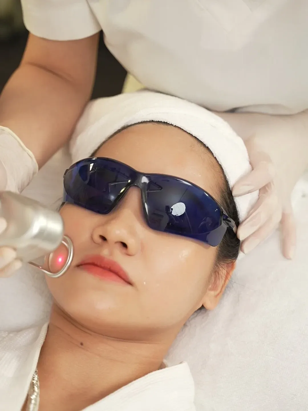 Cận cảnh kỹ thuật viên dùng đầu laser xử lý nốt trên má khách tại Sothic, khách đeo kính bảo hộ