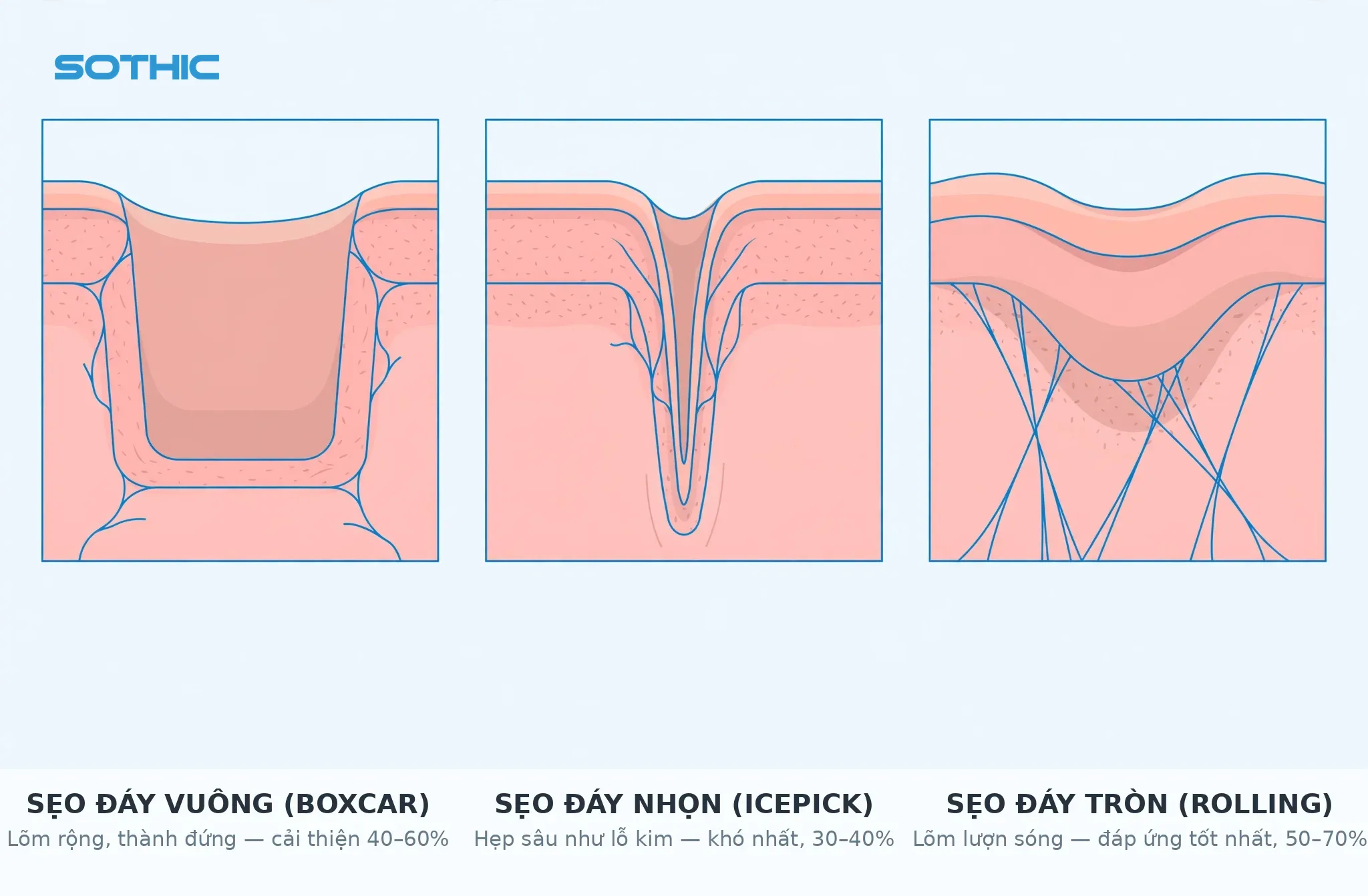 Sơ đồ minh họa 3 loại sẹo rỗ: sẹo đáy vuông (boxcar), sẹo đáy nhọn (icepick), sẹo đáy tròn (rolling) kèm khoảng phần trăm cải thiện