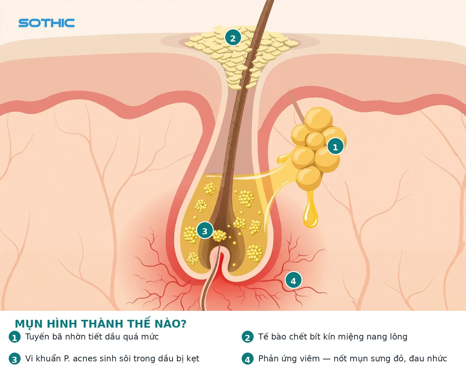 Infographic minh họa 4 yếu tố hình thành mụn: tuyến bã nhờn, tế bào chết bít tắc, vi khuẩn P. acnes, phản ứng viêm