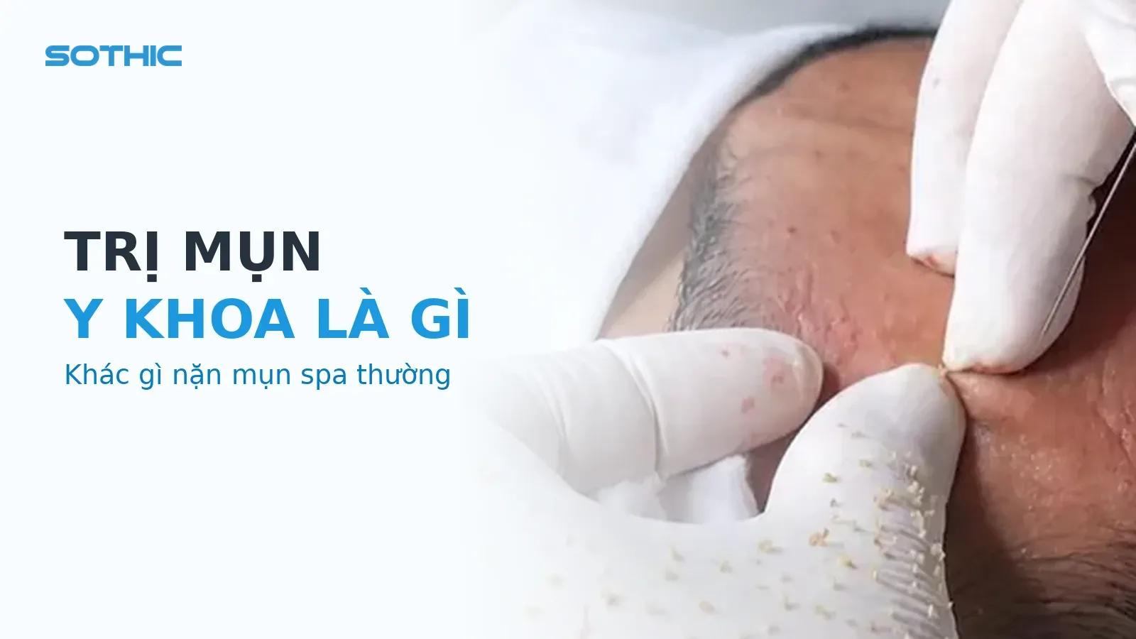Ảnh bìa bài viết Trị mụn y khoa là gì? Khác gì nặn mụn ở spa? — ảnh cận cảnh lấy nhân mụn, chữ TRỊ MỤN / Y KHOA LÀ GÌ