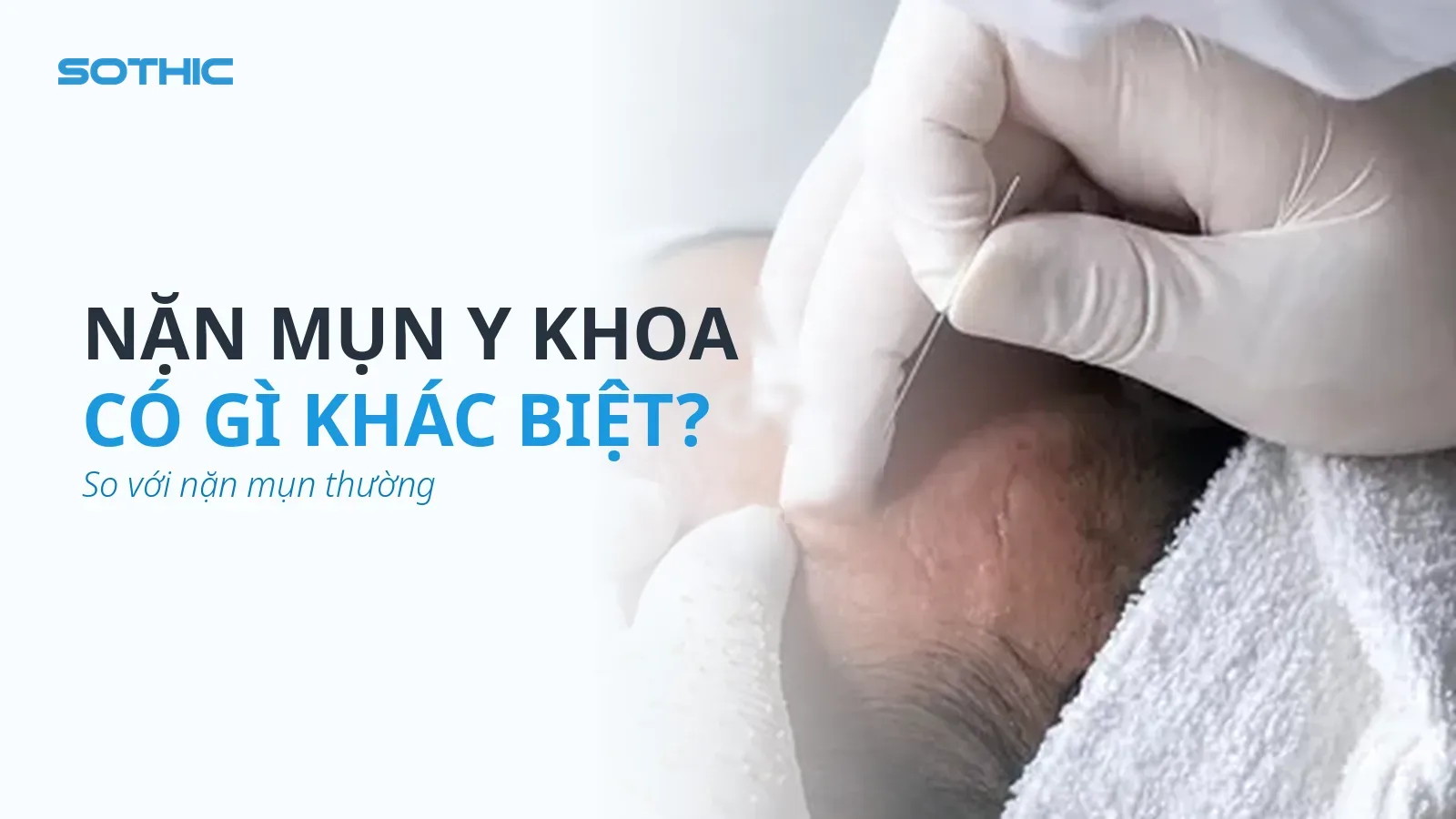 Thumbnail bài viết Nặn mụn y khoa và nặn mụn thường khác nhau thế nào — chữ NẶN MỤN Y KHOA / CÓ GÌ KHÁC BIỆT? / So với nặn mụn thường