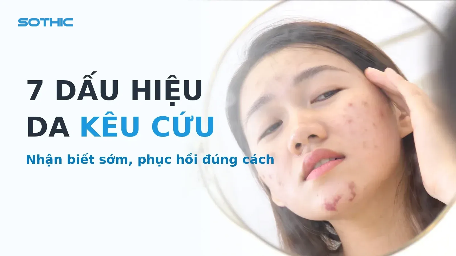 Thumbnail bài phục hồi hàng rào bảo vệ da: 7 dấu hiệu da đang kêu cứu — ảnh da mụn nặng soi gương