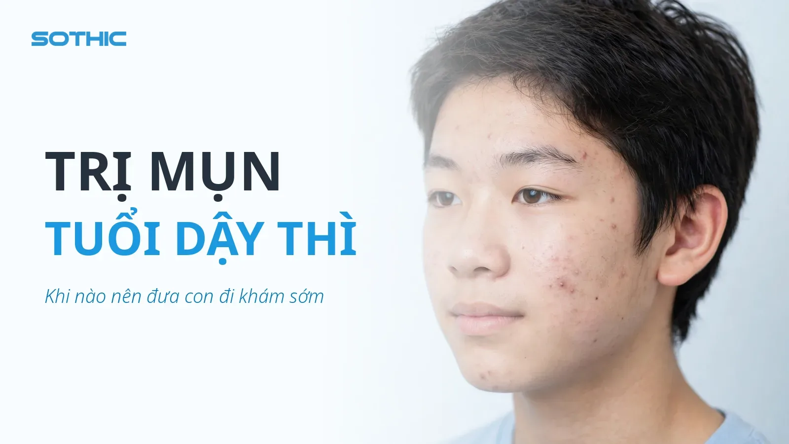 Thumbnail bài viết Mụn tuổi dậy thì: khi nào bạn nên đưa con đi khám — chữ TRỊ MỤN TUỔI DẬY THÌ, ảnh thiếu niên châu Á bị mụn