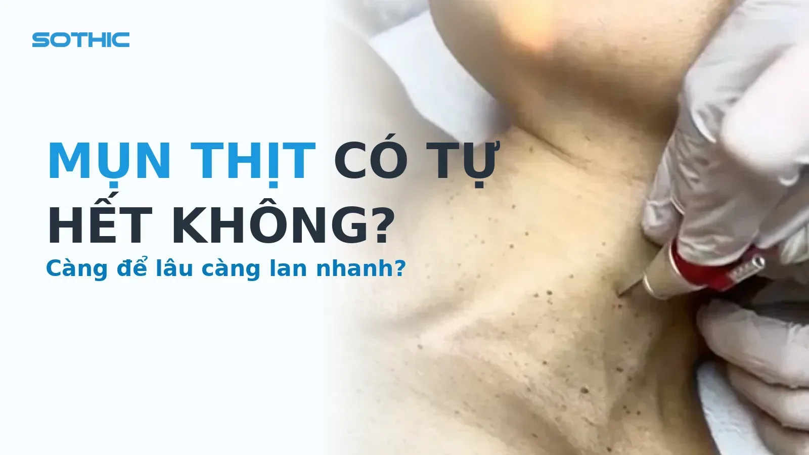 Thumbnail bai Mun thit co tu het khong: ky thuat vien dot mun thit vung co, chu MUN THIT CO TU HET KHONG