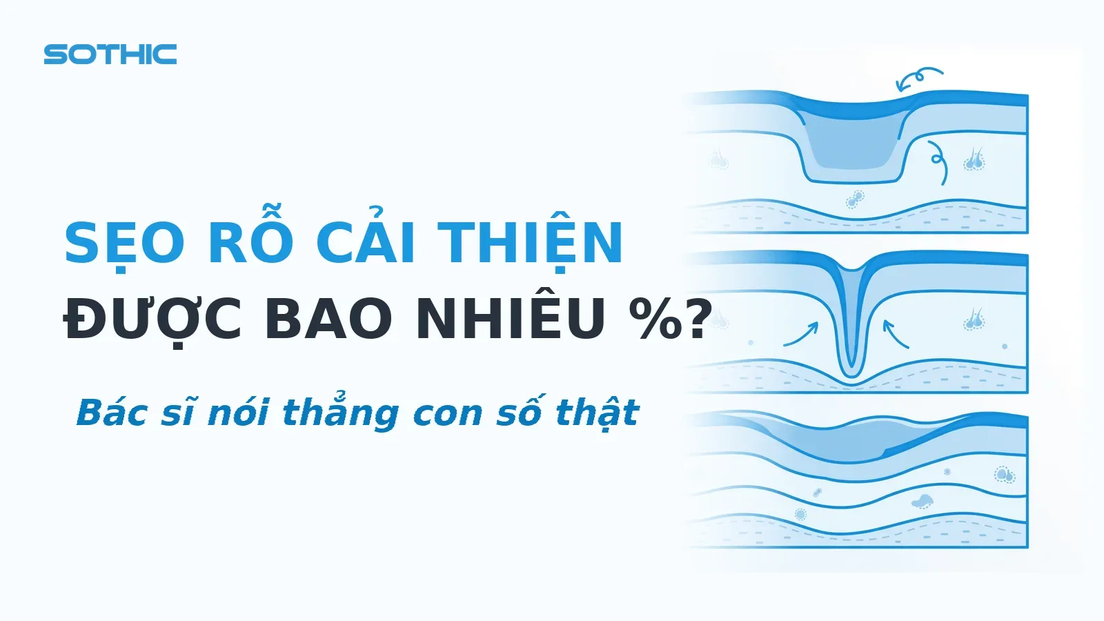 Thumbnail bài viết Trị sẹo rỗ hiệu quả bao nhiêu phần trăm: chữ SẸO RỖ CẢI THIỆN ĐƯỢC BAO NHIÊU PHẦN TRĂM và sơ đồ minh họa 3 loại sẹo rỗ