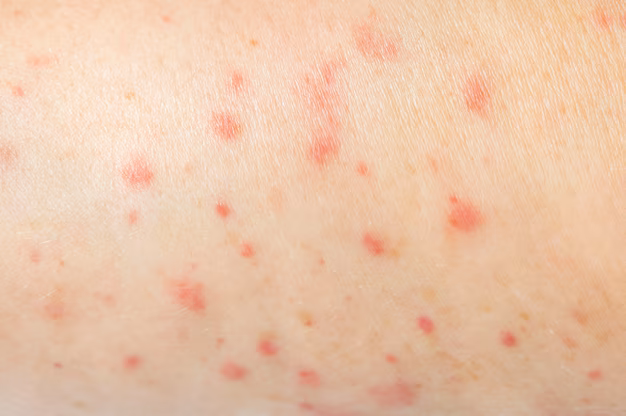 Cách Phân Biệt Các Loại Mụn Để Điều Trị Hiệu Quả