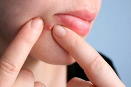 Điều trị mụn có cần nặn mụn, lể mụn hay không?